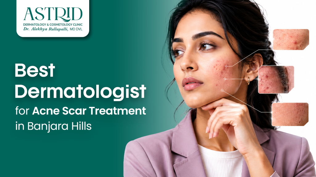 Best Dermatologist for Acne Scar Treatment in Banjara Hills