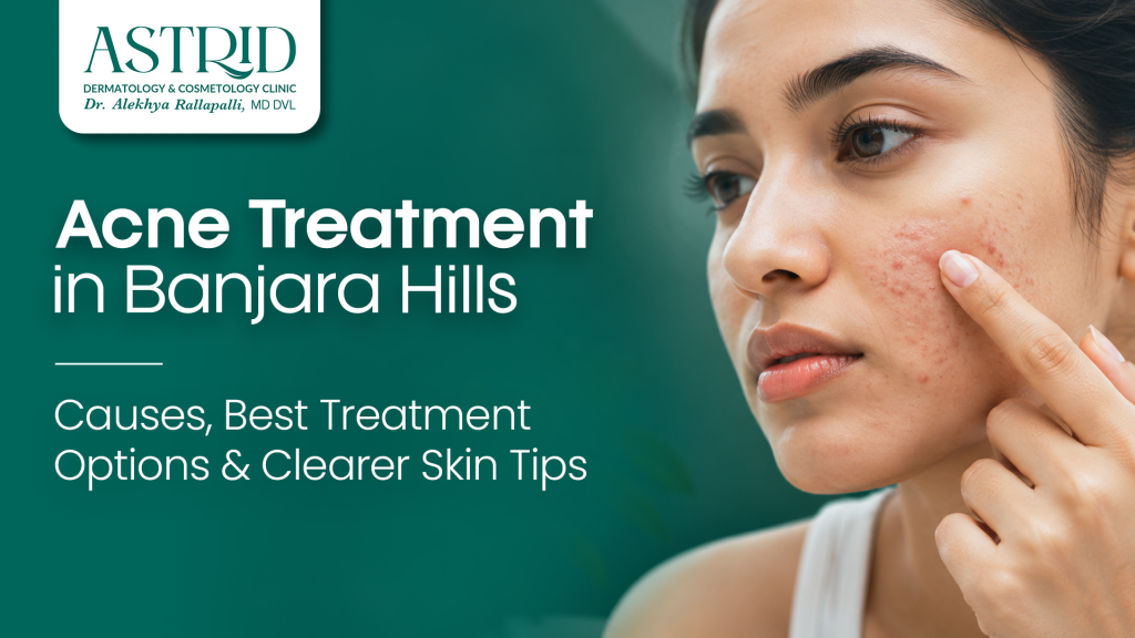 Acne Treatment in Banjara Hills – Causes, Best Treatment Options & Clearer Skin Tips