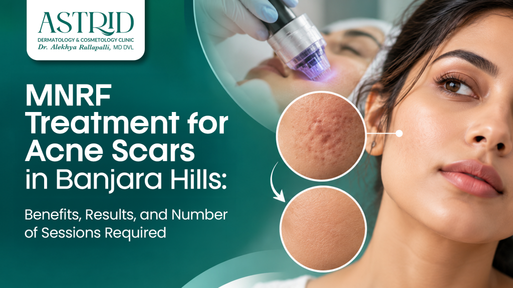 MNRF Treatment for Acne Scars in Banjara Hills: Benefits, Results, and Number of Sessions Required